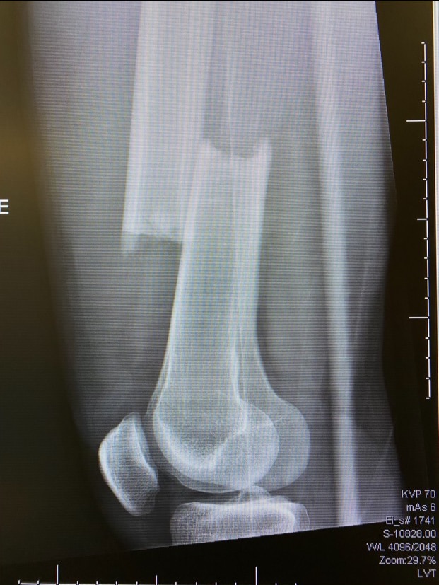 Easton Brodzinski's broken right femur. 